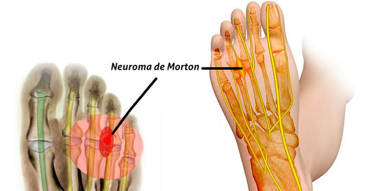 Neuroma de Morton