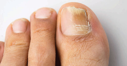 Onicomicosis