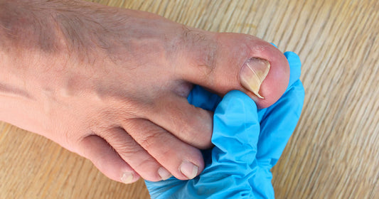 Uñas encarnadas